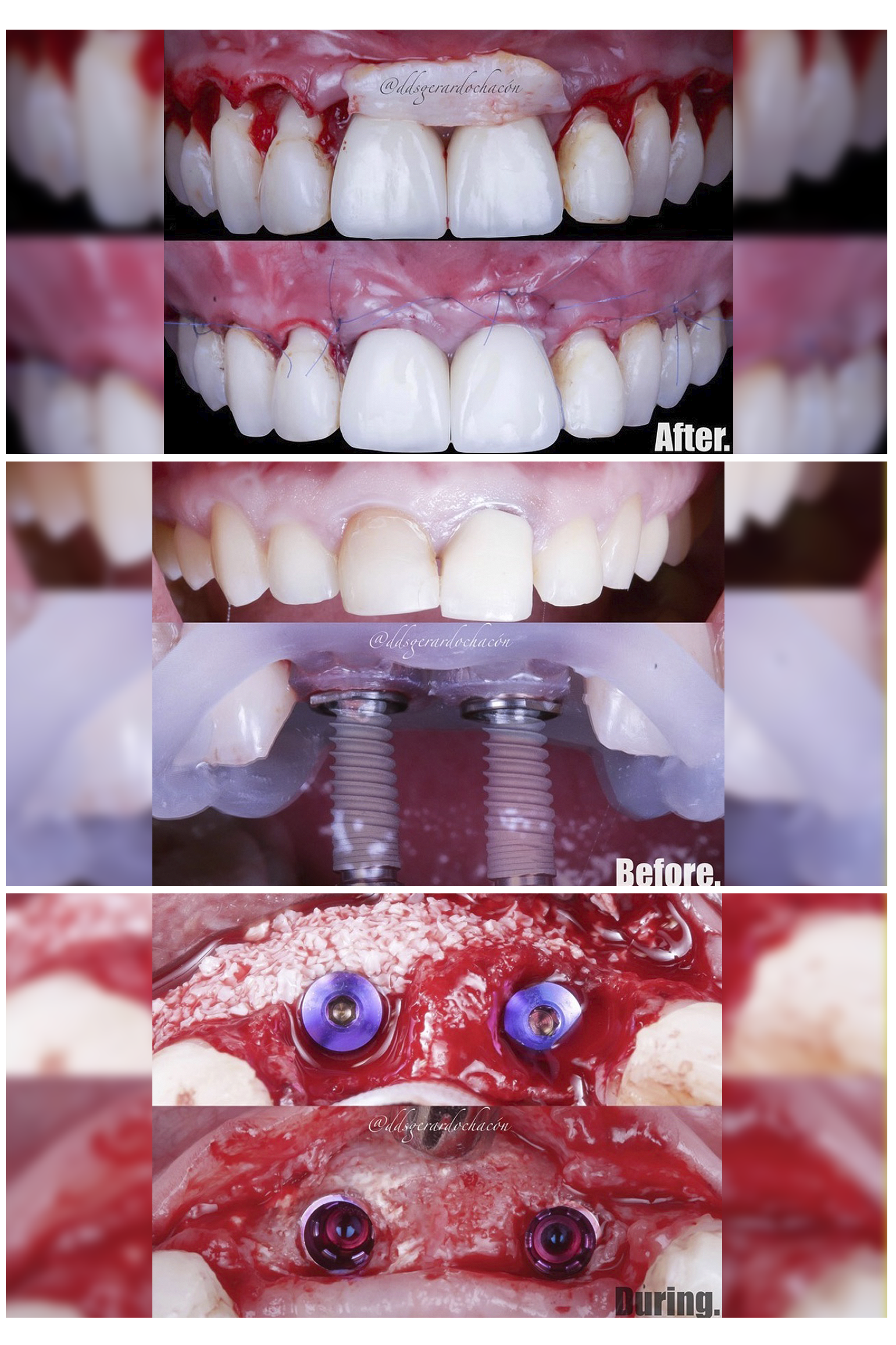 Implantes dentales MIS Implants V3 POR EL dr. gerardo chacon